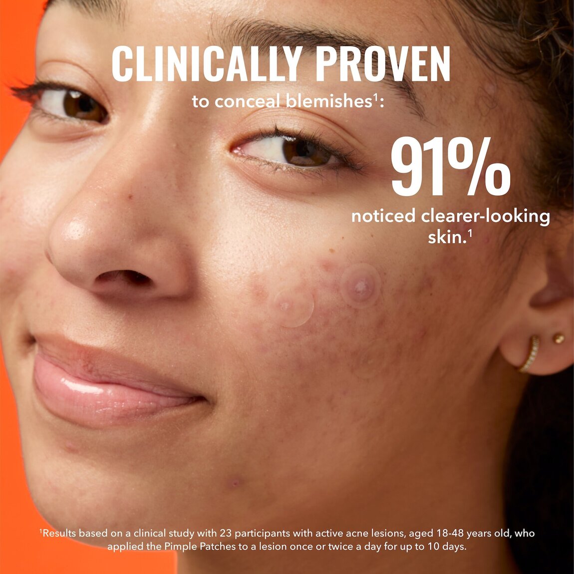 pimple-patches-h3 zb_p.jpg